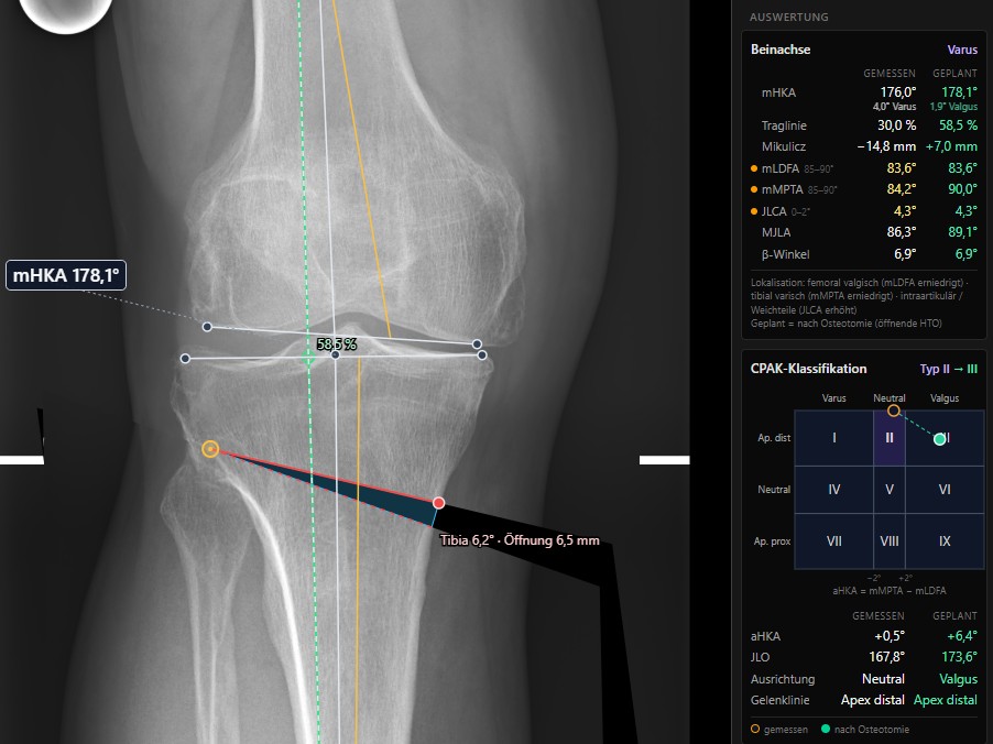 Öffnende hohe Tibiaosteotomie (HTO) am Knie mit Keil, neuer Traglinie und Bildsimulation, daneben die Ergebnisspalte mit Achswerten gemessen und geplant sowie CPAK-Klassifikation II → III